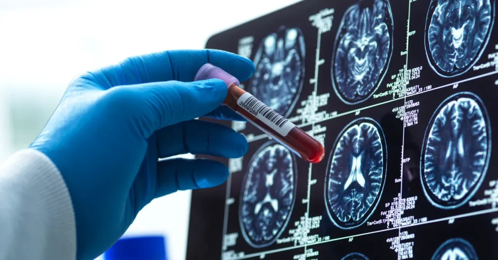 Blood Tests for Alzheimer’s Are Here