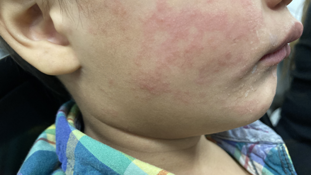 Measles continues raging in South Carolina; 99 new cases since Tuesday Measles continues raging in South Carolina; 99 new cases since Tuesday