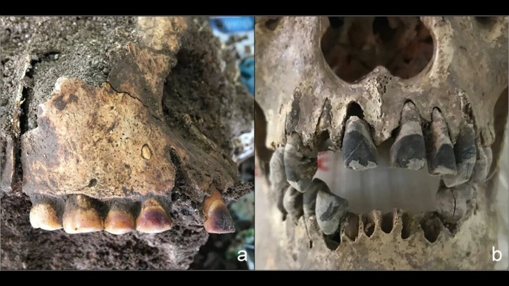 2,000-Year-Old Skulls Reveal How Vietnam’s Early Influencers Dyed Their Teeth Pitch Black—For Life