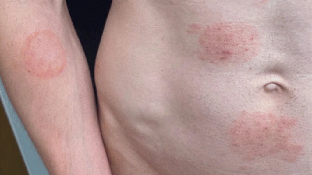 A STI Fungus Is Making Itself Cozy in the US