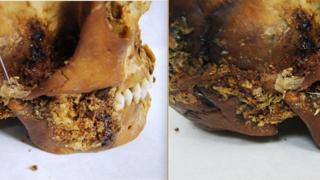 Iron Age Surgeons Fixed a Woman’s Shattered Jaw With Primitive Prosthetic—and She Survived Iron Age Surgeons Fixed a Woman's Shattered Jaw With Primitive Prosthetic—and She Survived
