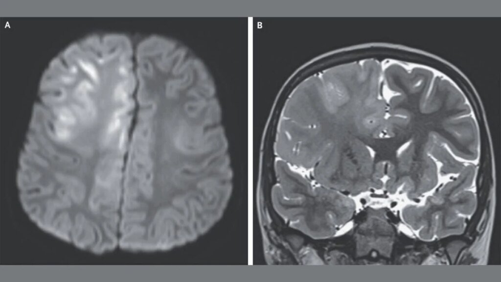 This Is What a Brain Destroyed by Measles Looks Like This Is What a Brain Destroyed by Measles Looks Like